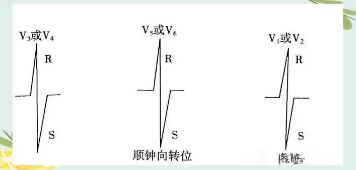 心电轴的精确测量与心脏长轴转位的判定方法