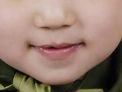 唇裂修补的手术方法步骤