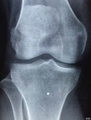 看看这个片子股骨外侧髁像什么