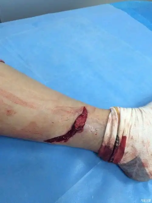 就是这个伤口,看着太大了,好害怕