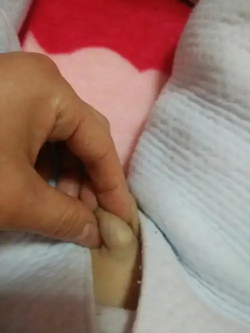 男孩两岁两个月,生殖器上长疙瘩怎么回事啊,白白的那一点,软软的