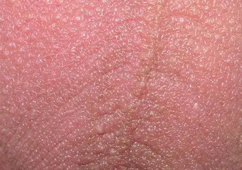 睾丸阴囊上长有硬疙瘩图片大全及原因_银屑病求医网