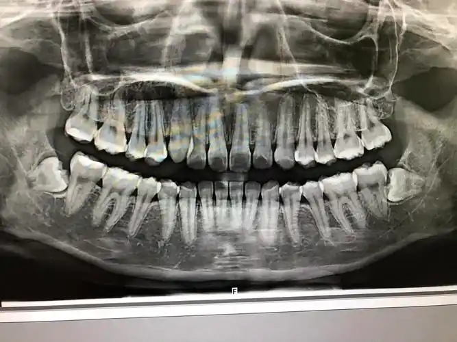 追加我的牙片喉咙旁边的口腔壁有淤,不是凸起的,就是感觉,内伤那种