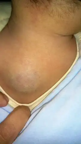 海绵状血管瘤 急!急!急!拜托大家了