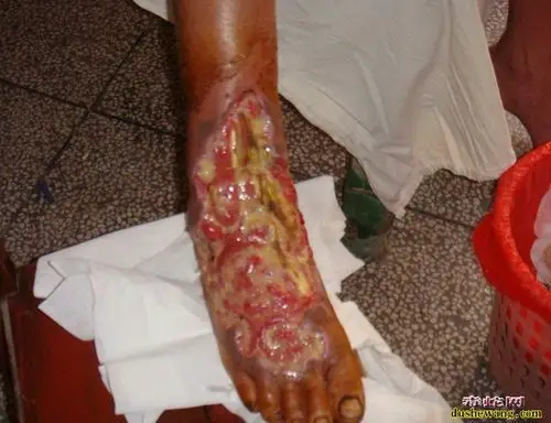 五步蛇咬伤腐烂恐怖的咬伤已经植皮的咬伤患者手臂咬伤的手指基本没有