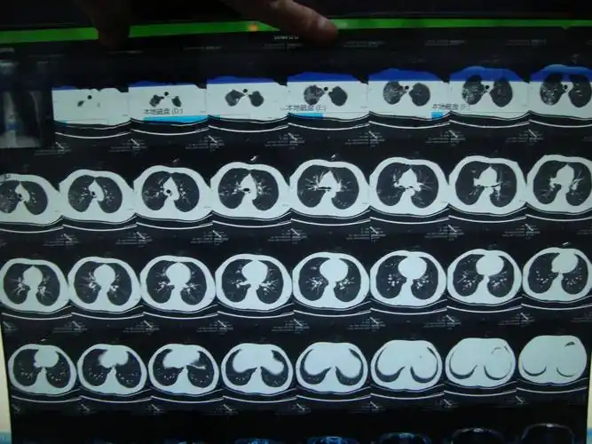 请高手看看肺结核ct