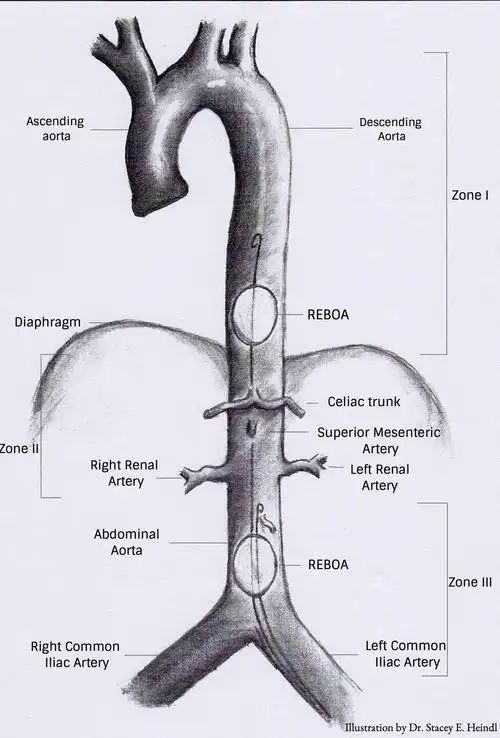 partial versus complete resuscitative endovascular b