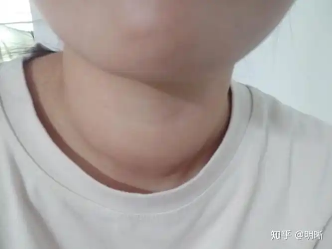 甲亢随笔时隔一年终于好啦