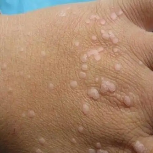 身体上张扁平疣图片