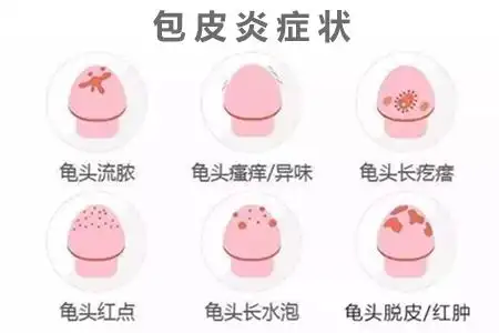 性包皮傀头炎与其他类型傀头炎相比较为特殊,发病之后不但会出现红斑