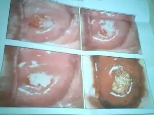 宫颈湿疣怎么办,上海哪家妇科医院治疗最好