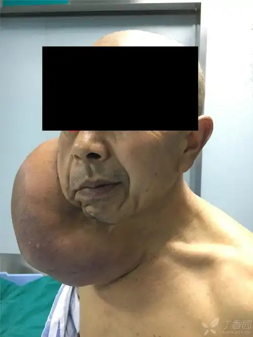 【讨论】颈部巨大脂肪瘤一例 - 修复重建和烧伤整形 -丁香园论坛
