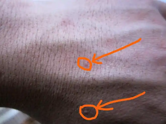 手背上长了小肉陀,不疼不痒