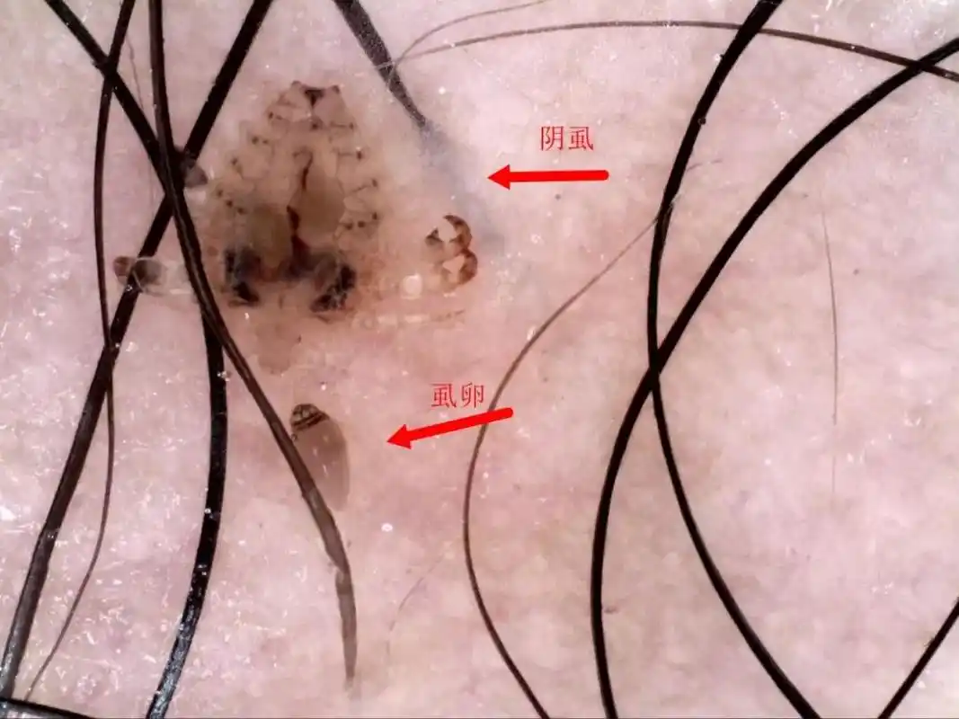 剧痒难耐,难以启齿,关键会……_阴虱