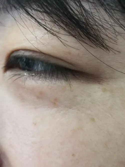 解决皮肤问题专注皮肤美容##黄褐斑##雀斑