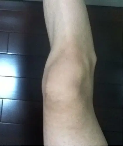 图片膝盖外侧骨头突出图片膝盖外侧骨头突出图片这个部位是腓骨小头