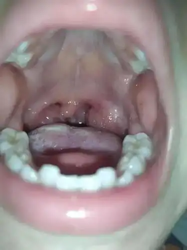 腺样体肥大什么情况下要做手术?