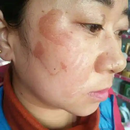 真皮斑怎么掉_百科-8s新商盟