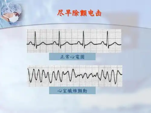 尽早除颤电击 正常心电图 心室纤维颤动
