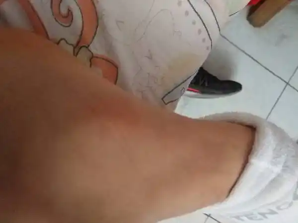 副舟骨突出运动多了会有痛能当兵吗