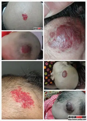 【图解】各类头部血管瘤的危害