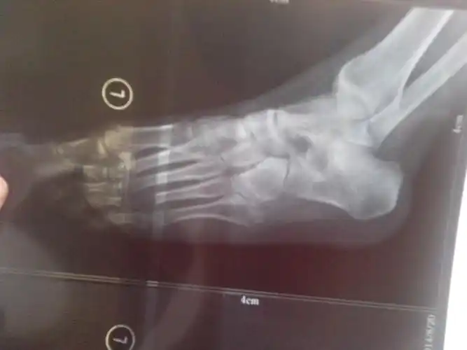 左足第五跖骨骨折,请教一下痊愈方面的问题