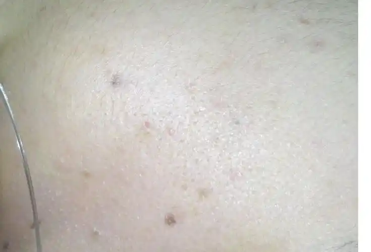 我脸上的黑点算是哪种披皮肤病