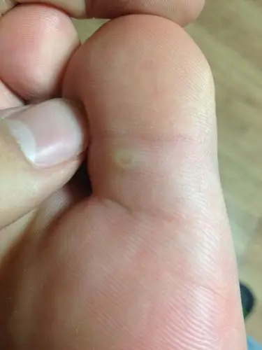 这两天球队训练多,回来就发现脚上长了个这.