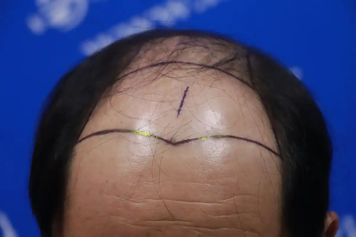 男士大面积脱发,秃顶.#商丘 #图文#秃顶 #头发 #植发  - 抖音