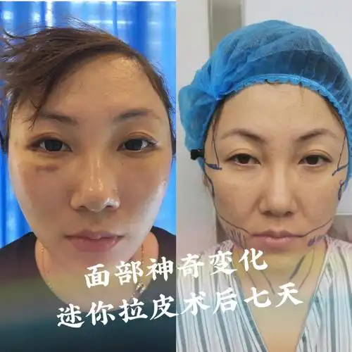 拉皮 术后第七天,能够看到皮肤这几天变得越来越好了,才做完手术的