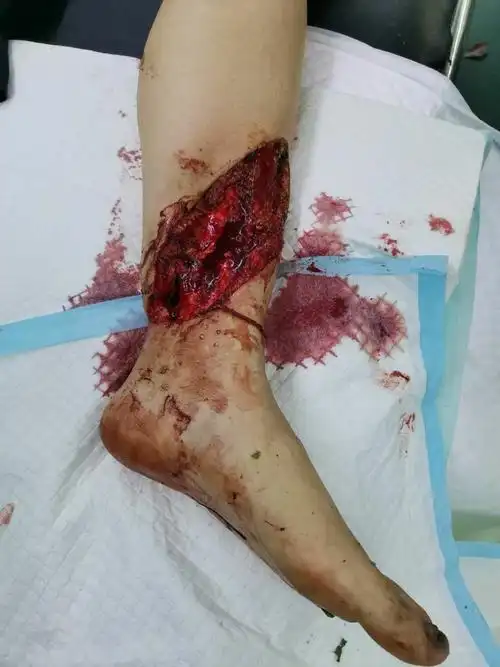 结合患者受伤史,伤口污染较重.