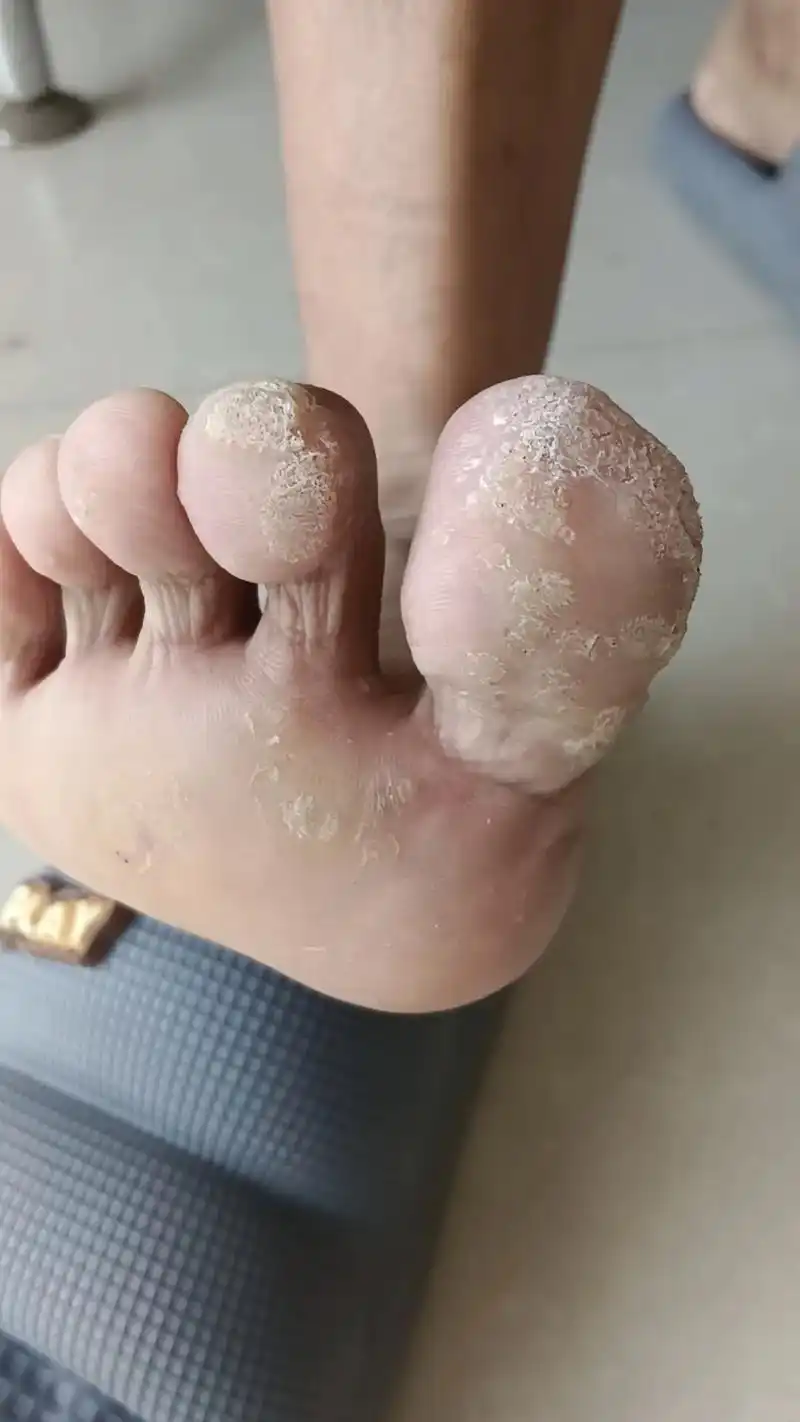 跖疣 治疗1个月前后效果图 - 抖音