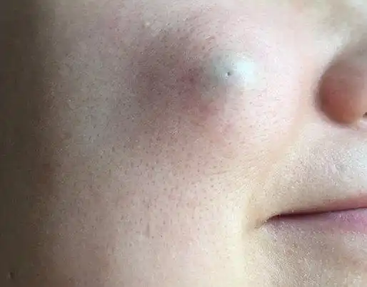 面部表皮囊肿_胆脂瘤_介绍_症状表现 - 好大夫在线