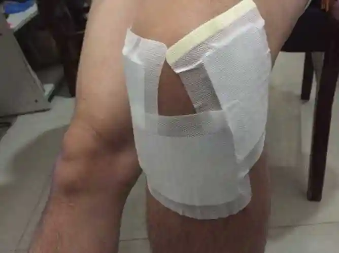 术后伸膝位加压包扎,次日开始作四头肌静止性收缩练习,2～3天后开始作