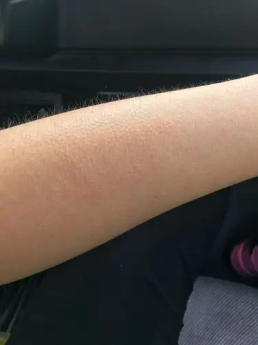 胳膊上起了一片这样的像鸡皮疙瘩.