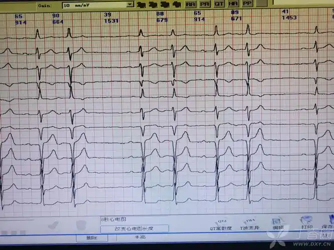 心律失常的心电图