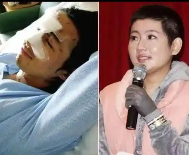 俞灏明烧伤,俞灏明受访称《八佰》烧伤镜头不是特效,时隔多年在揭伤疤