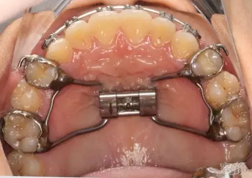 散在间隙,要注意检查是否存在不良习惯 牙弓变化1,上颌牙弓长度增加1