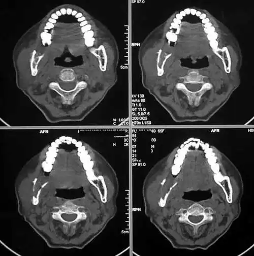 下颌骨占位分析-ct--已公布答案:4月27日