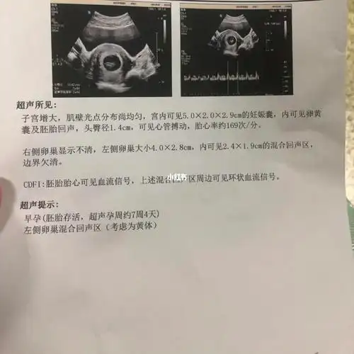 一胎已经7周岁77,相比二胎,现在回忆起来就像怀了个假孕.