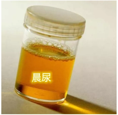 【你尿对了吗】尿液标本,留取很有讲究