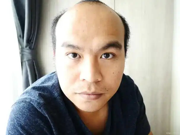 "地中海"发型,顾名思义,是指男性头顶中央逐渐稀疏,两侧头发密集,形似