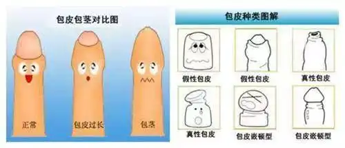 包皮过长,包茎为什么要割?请听世檀塔男科医院李昶旼说