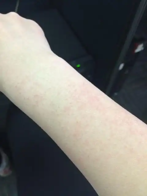 孕4月皮肤起红点