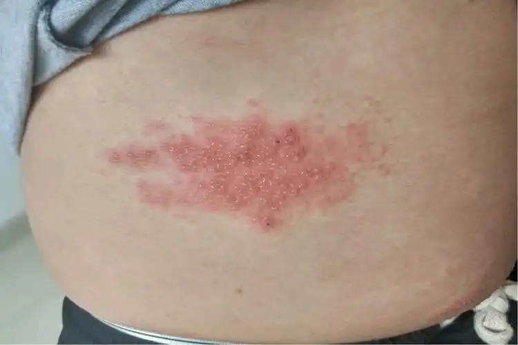 1,单纯疱疹感染:单纯疱疹感染通常是由于单纯疱疹病毒引起的感染,通常