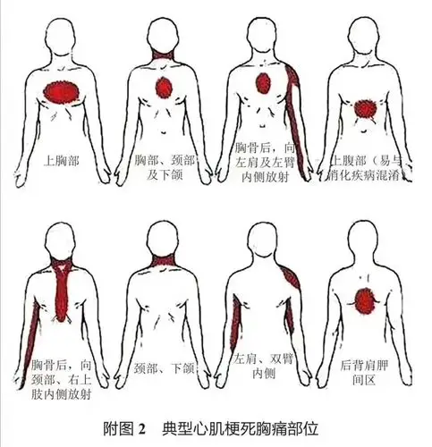 急性心肌梗死的典型疼痛部位
