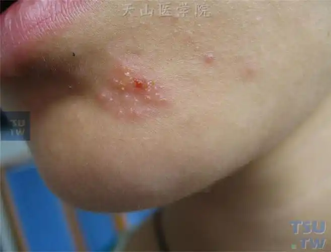 单纯疱疹(herpes simplex)症状表现