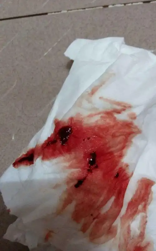 月经出血延长的原因有哪些 月经出血持续长短取决于什么