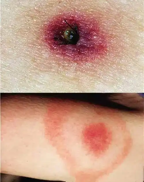 四,蜱虫叮咬之后有何症状?