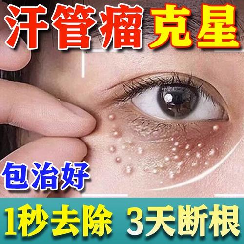 包断裉】汗管瘤眼部去除神器专用去除眼周脂肪粒油脂粒扁平状膏